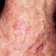 actinic keratosis horn