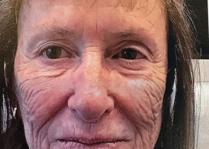 1.-Wrinkles-before-Acelift