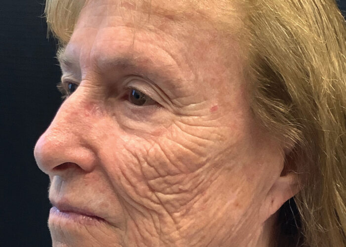 2.-Left-side-wrinkles,-melanoma-visible