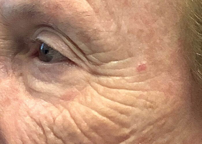 3.-Closeup-of-pink-melanoma-before-biopsy