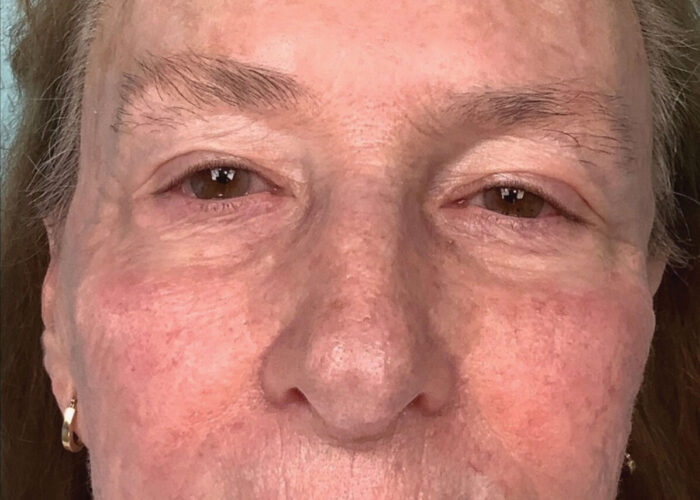 4.-Redness-after-Acelift