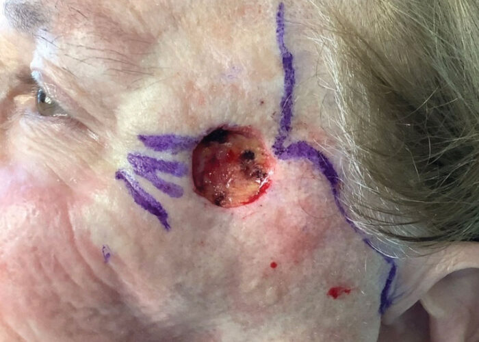 5.-Melanoma-surgical-excision