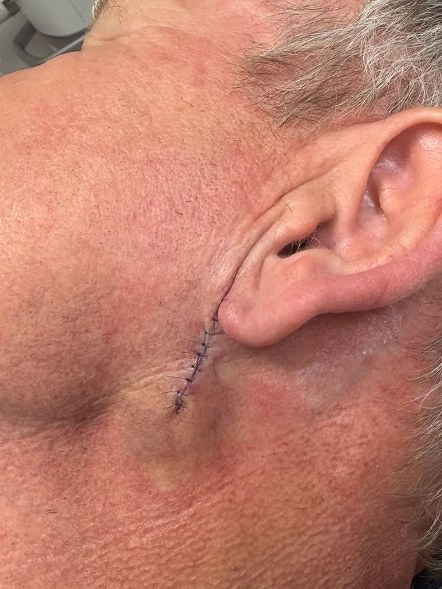 Surgery scar
