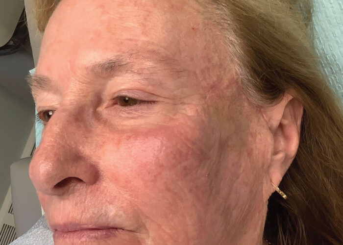 7.-One-month-after-suture-removal