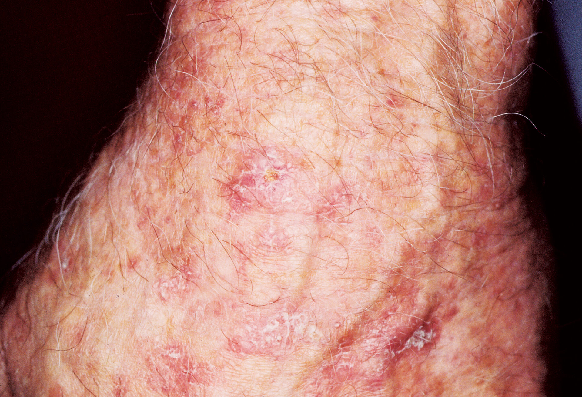 Actinic Keratosis Warning Signs And Images