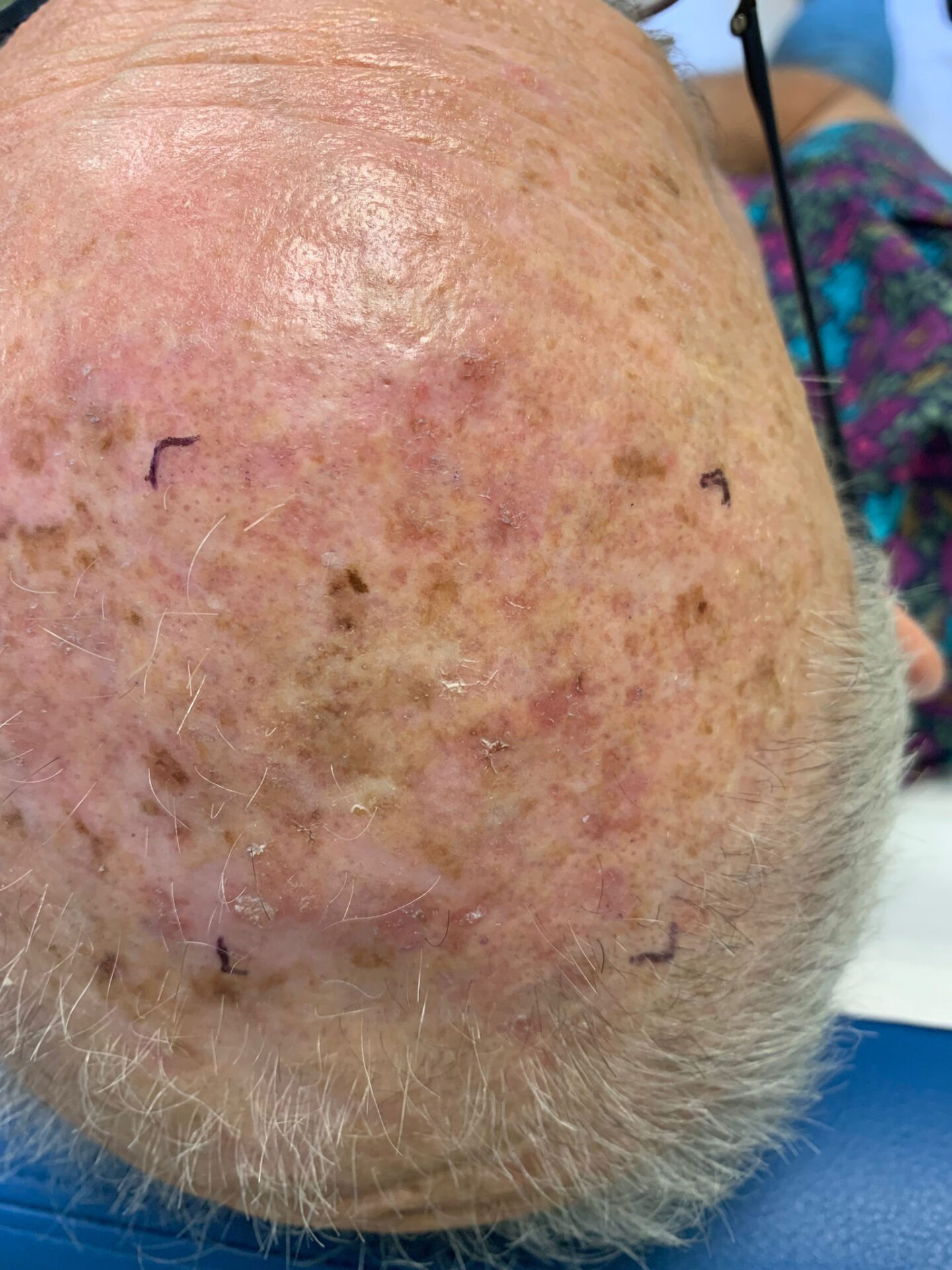 Queratosis actínicas en el cuero cabelludo