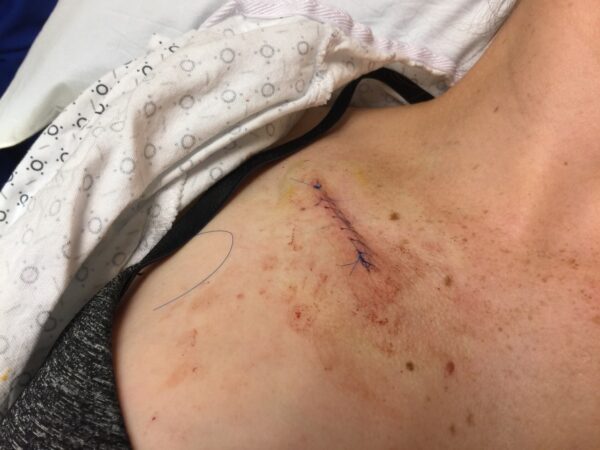 Melanoma surgical scare on young woman.