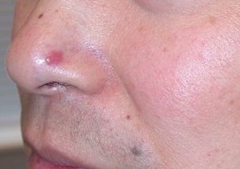 basal cell carcinoma nose scar