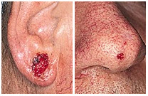 basal cell carcinoma bcc