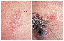 picture basal cell carcinoma on man's left eyebrow