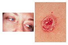 basal cell carcinoma bcc