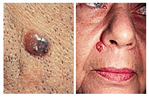 basal cell carcinoma woman's face