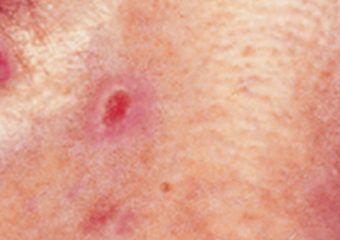 Le Carcinome Basocellulaire - The Skin Cancer Foundation