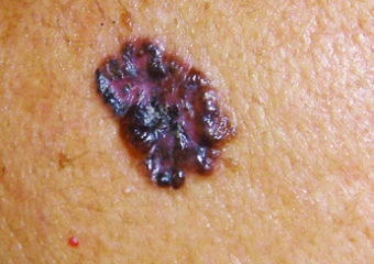 A basal cell carcinoma may be pigmented, like this one, on skin of color.