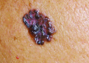 late squamous cell carcinoma