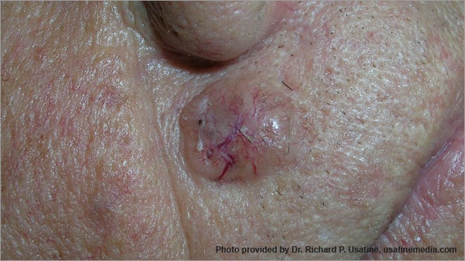 Carcinoma de células basales, bulto brillante sobre el labio superior