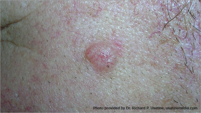 Carcinoma de células basales: protuberancia brillante