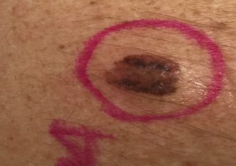 stage 1a melanoma