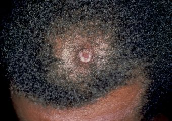 squamous cell carcinoma on the scalp of a Black man