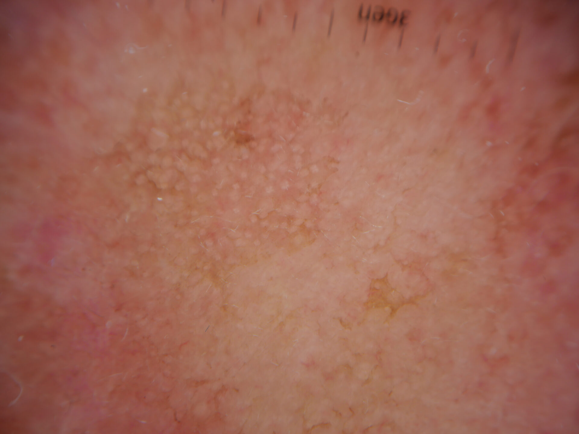 Primer plano de queratosis actínicas en el cuero cabelludo.
