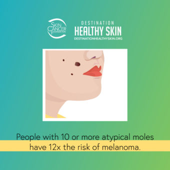 People with 10 or more atypical moles have 12x the risk of melanoma