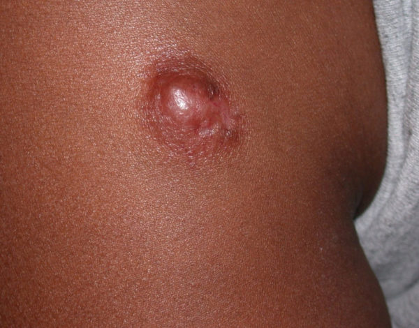 Dermatofibrosarcoma protuberans