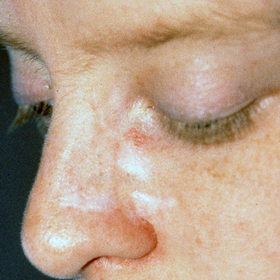 basal cell carcinoma eyelid