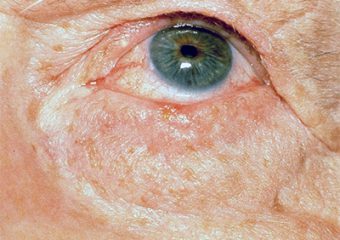 basal cell carcinoma lower eyelid lash line