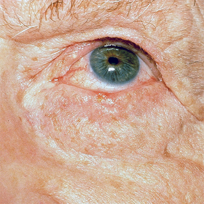 basal cell carcinoma lower eyelid lash line