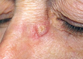 crusty spot eye squamous cell carcinoma