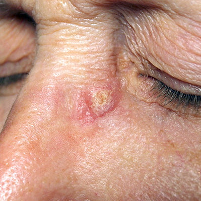 crusty spot eye squamous cell carcinoma