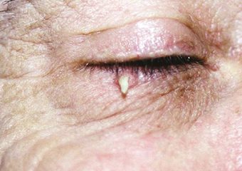cutaneous horn squamous cell carcinoma lower eyelid