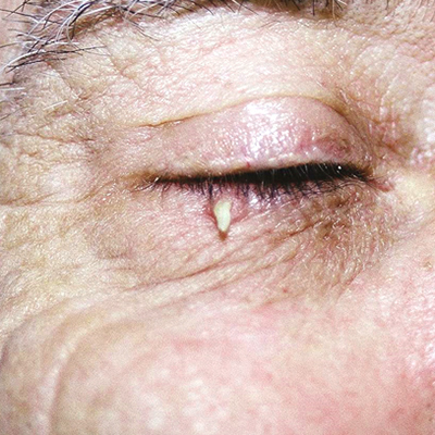 cutaneous horn squamous cell carcinoma lower eyelid