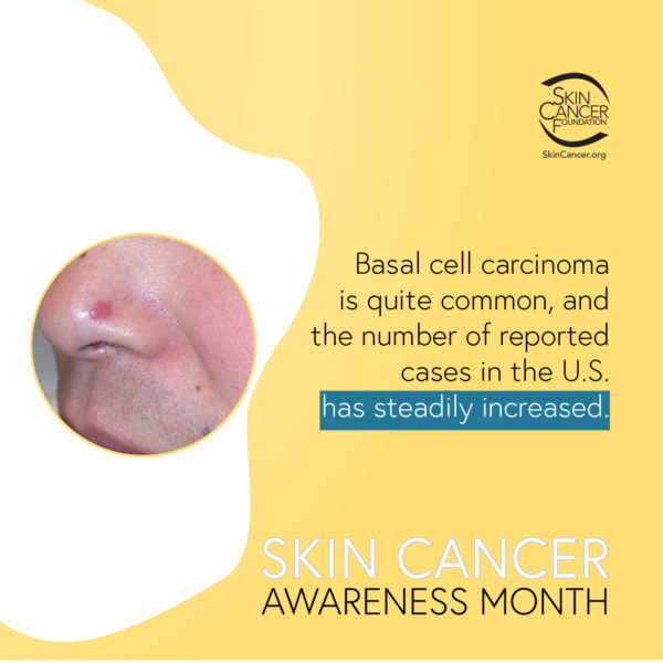 Basal cell carcinoma is quite common, and the number of reported cases in the U.S. has steadily increased