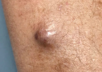 Merkel cell carcinoma