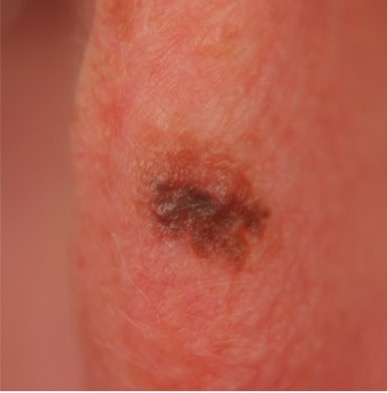 melanoma in situ