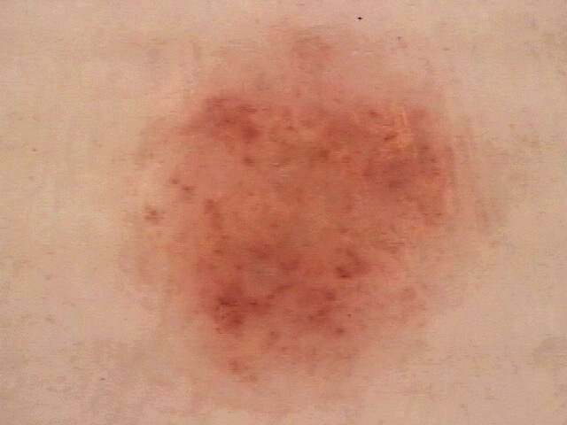 Queratosis actínica
