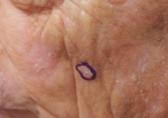 squamous cell carcinoma circled on cheek