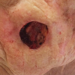 large surgical wound after removing tumor on cheek