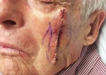 cheek with stitches after Mohs surgery for squamous cell carcinoma