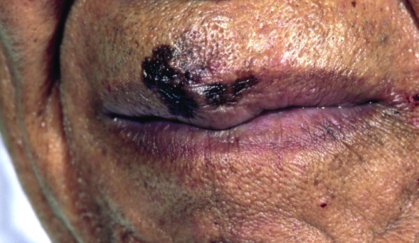 Melanoma on the lip of a Black man