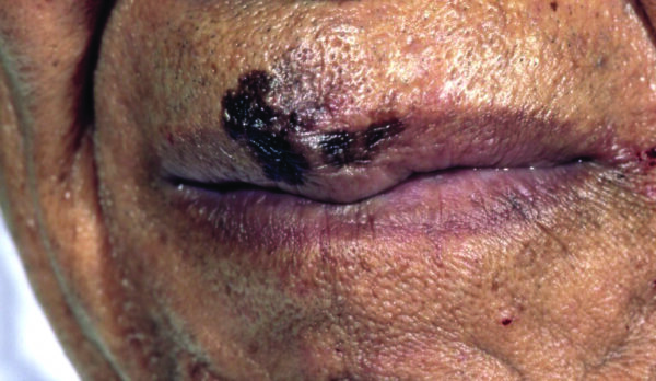 Melanoma nos lábios de um homem negro