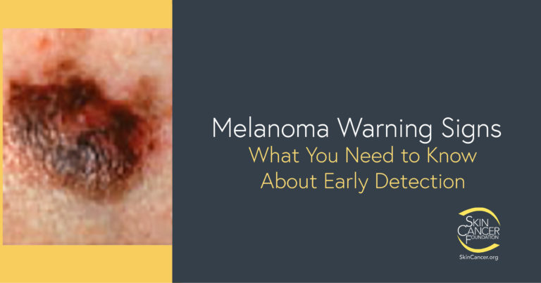 Picture of skin cancer, melanoma with the text Melanoma Warning Signs