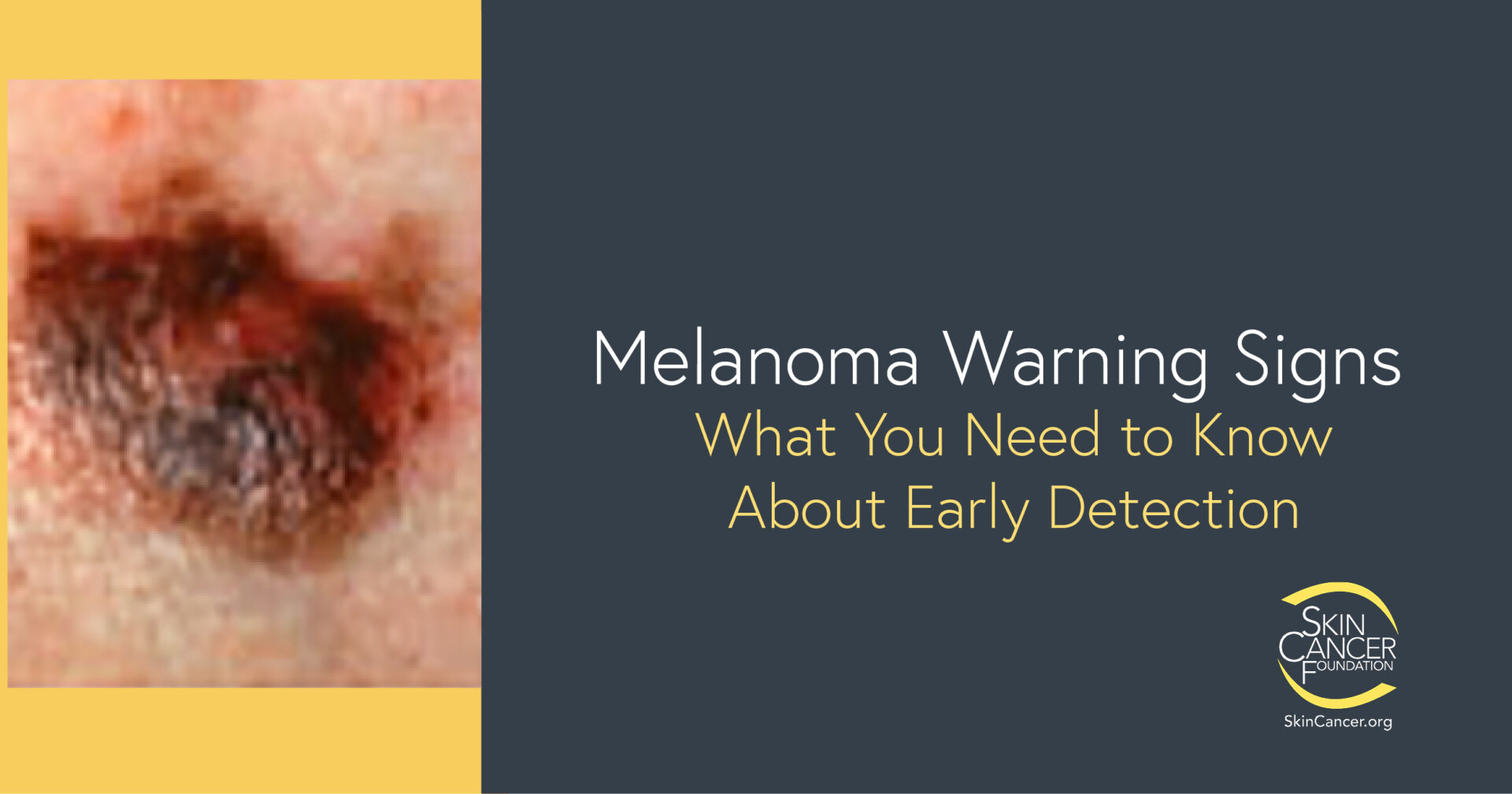 Melanoma