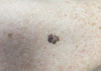 Melanoma, 1.3mm, right posterior shoulder. Photo: Sarah Gee, MD