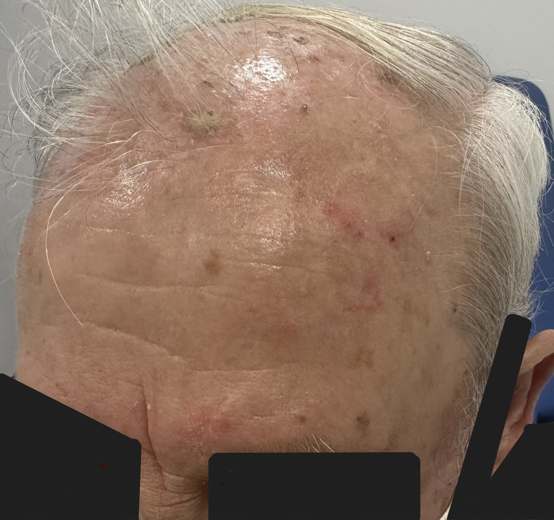 Queratosis actínicas múltiples en el cuero cabelludo
