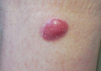 merkel cell carcinoma on the lower leg