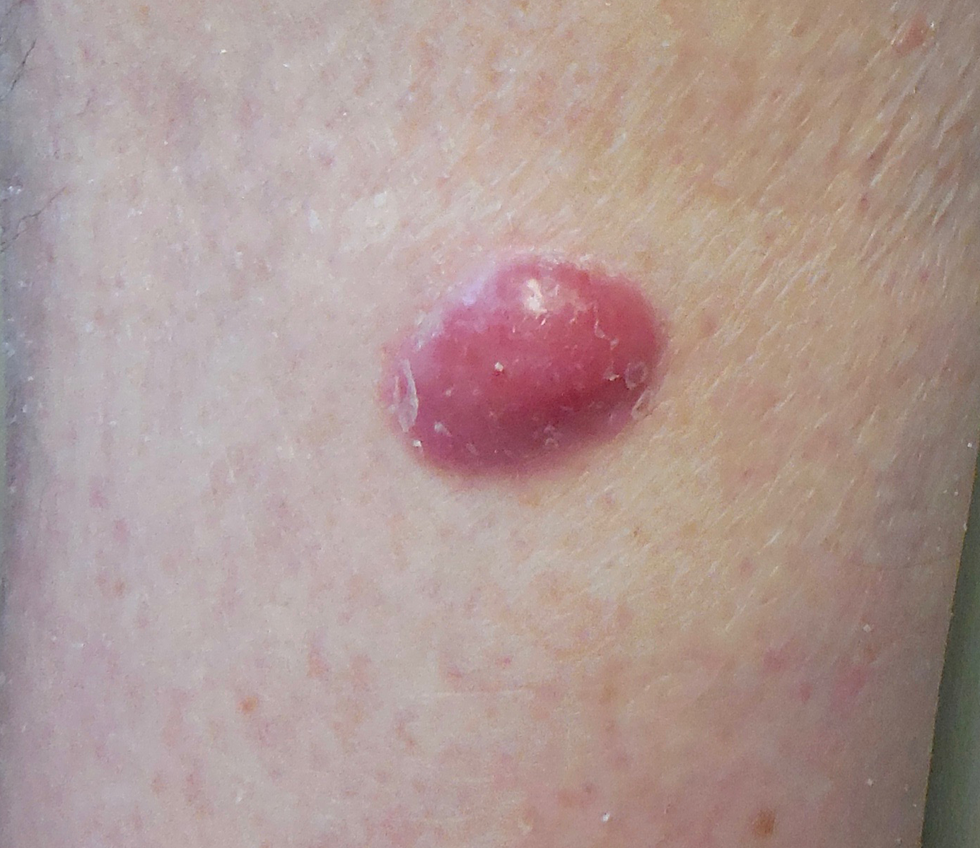 Merkel Cell Carcinoma Warning Signs And Images The Skin Cancer