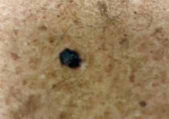 Nodular melanoma 1.3mm on upper back