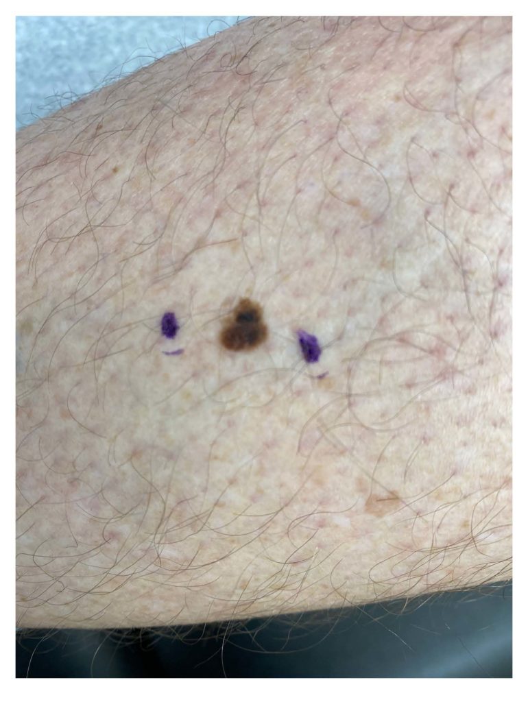 He Never Thought Skin Cancer Would Happen to Him. And Then It Did.